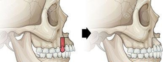 骨性龅牙矫正示意图