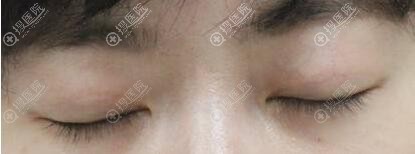 双眼皮疤痕用激光修复后的效果