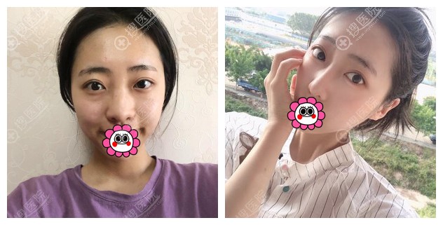 广州韩妃牟北平隆鼻效果