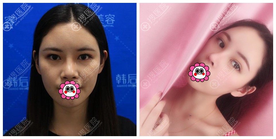 广州韩后崔东隆鼻案例