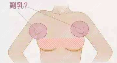 双侧副乳手术一般多少钱？