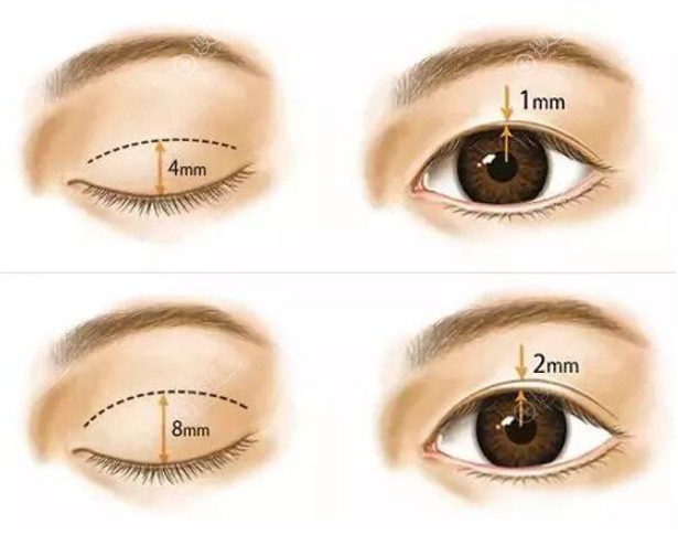 自然的双眼皮宽度是多少毫米