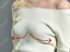 不得不说人工韧带乳房提升术矫正胸下垂效果不错,手术费用多少?